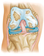 omaha knee arthritis